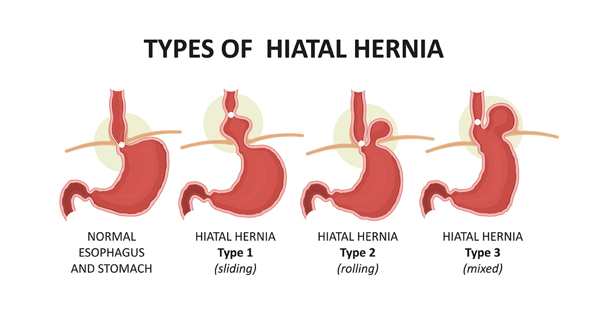 hiatus hernia fixed